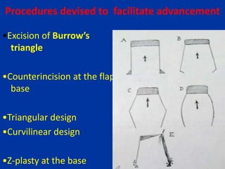 Procedures devised to facilitate advancement
•Excision of Burrow’s
triangle
•Counterincision at the flap
base
•Triangular design
•Curvilinear design
•Z-plasty at the base
 
