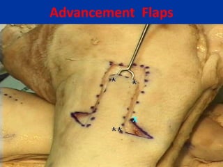 Advancement Flaps
 