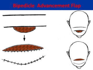 Bipedicle Advancement Flap
 