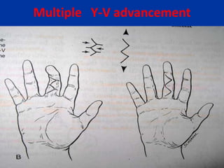 Multiple Y-V advancement
 