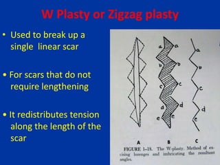 W Plasty or Zigzag plasty
• Used to break up a
single linear scar
• For scars that do not
require lengthening
• It redistributes tension
along the length of the
scar
 