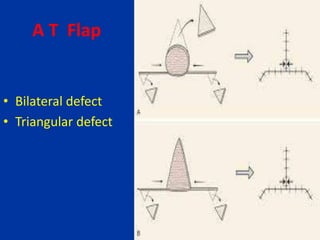 A T Flap
• Bilateral defect
• Triangular defect
 