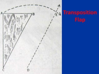 Transposition
Flap
 