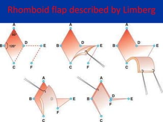 Rhomboid flap described by Limberg
 