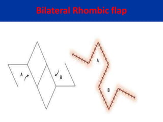 Bilateral Rhombic flap
 