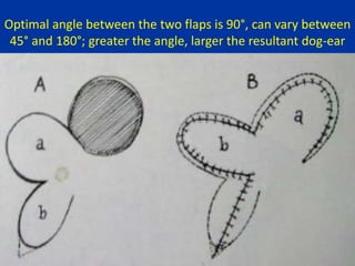 Optimal angle between the two flaps is 90°, can vary between
45° and 180°; greater the angle, larger the resultant dog-ear
 