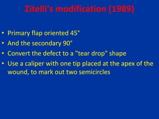 Zitelli's modification (1989)
• Primary flap oriented 45°
• And the secondary 90°
• Convert the defect to a "tear drop" shape
• Use a caliper with one tip placed at the apex of the
wound, to mark out two semicircles
 