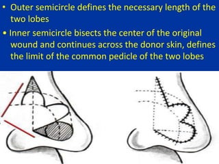 • Outer semicircle defines the necessary length of the
two lobes
• Inner semicircle bisects the center of the original
wound and continues across the donor skin, defines
the limit of the common pedicle of the two lobes
 