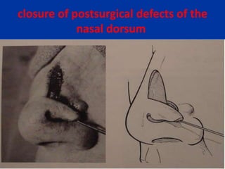 closure of postsurgical defects of the
nasal dorsum
 