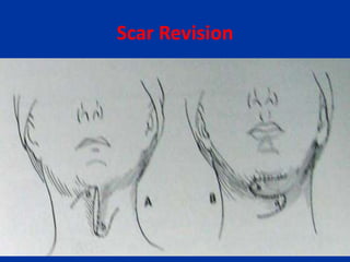 Scar Revision
 