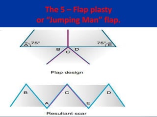 The 5 – Flap plasty
or “Jumping Man” flap.
 