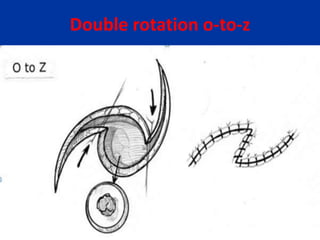 Double rotation o-to-z
 