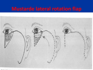 Mustarde lateral rotation flap
 