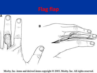Flag flap
 