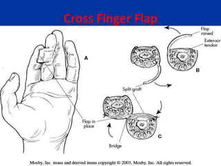Cross Finger Flap
 