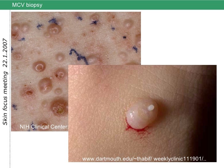 Skin barrier models-molluscum