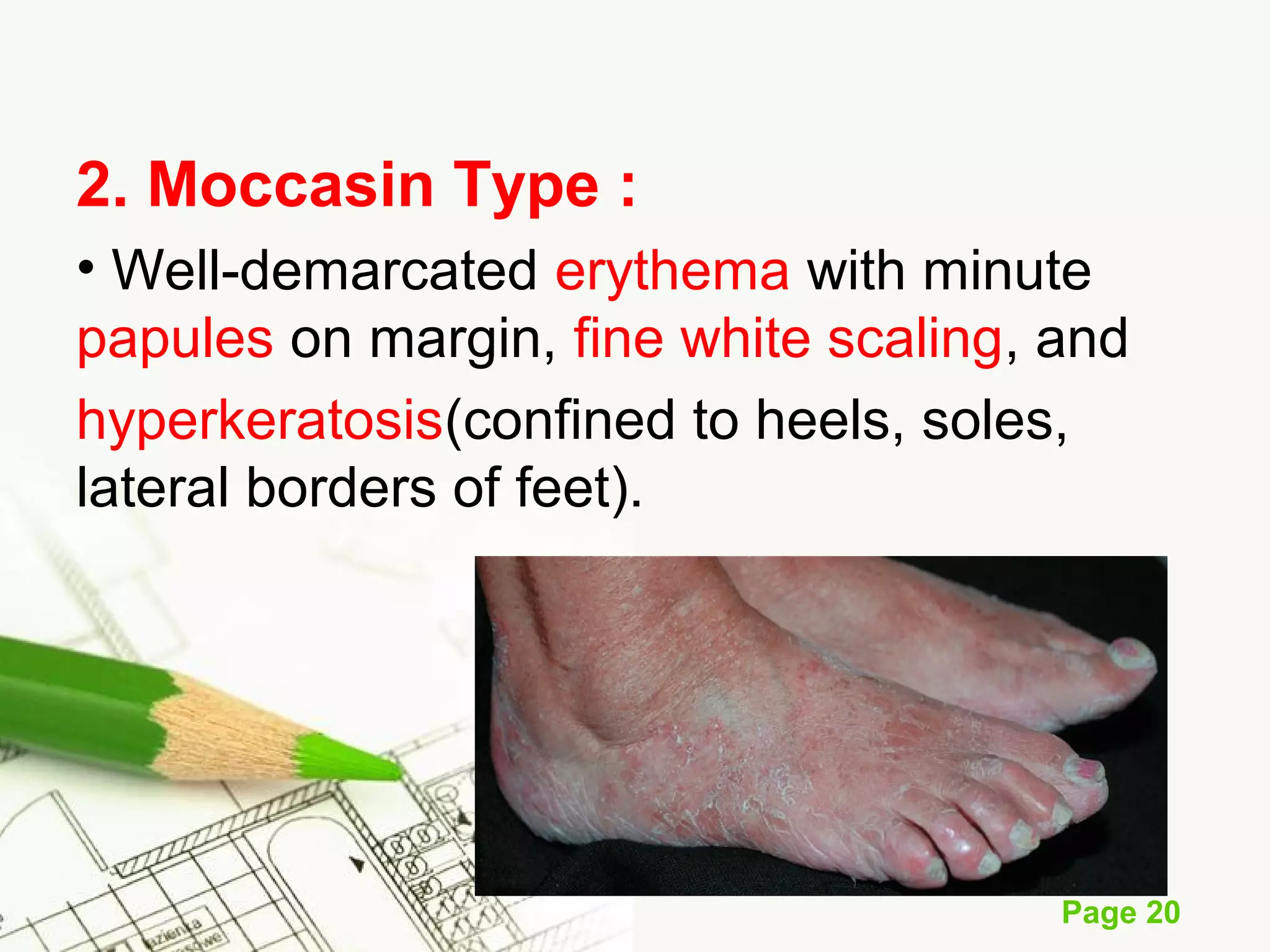 Skin fungal infection | PPT