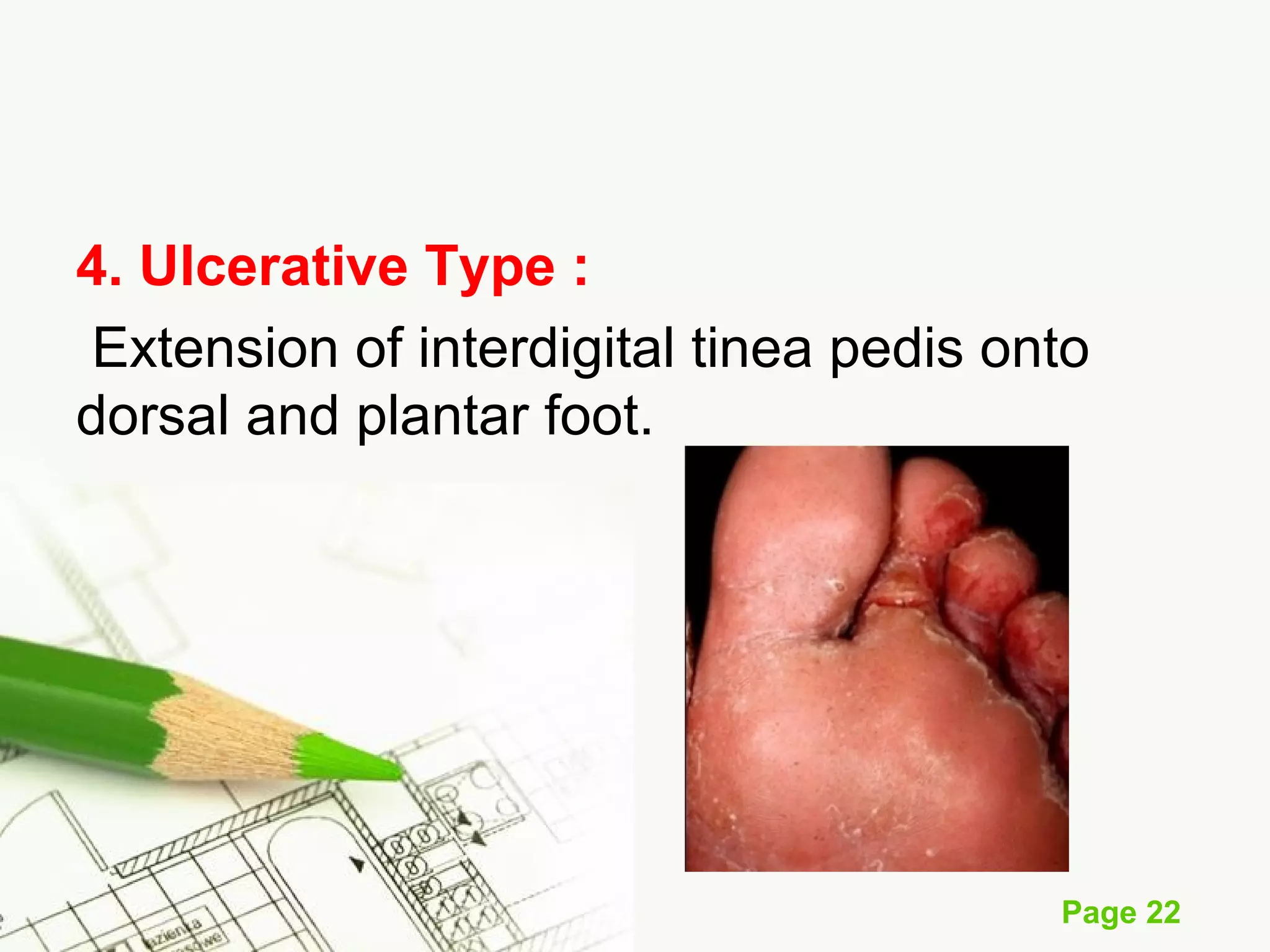 Skin fungal infection | PPT