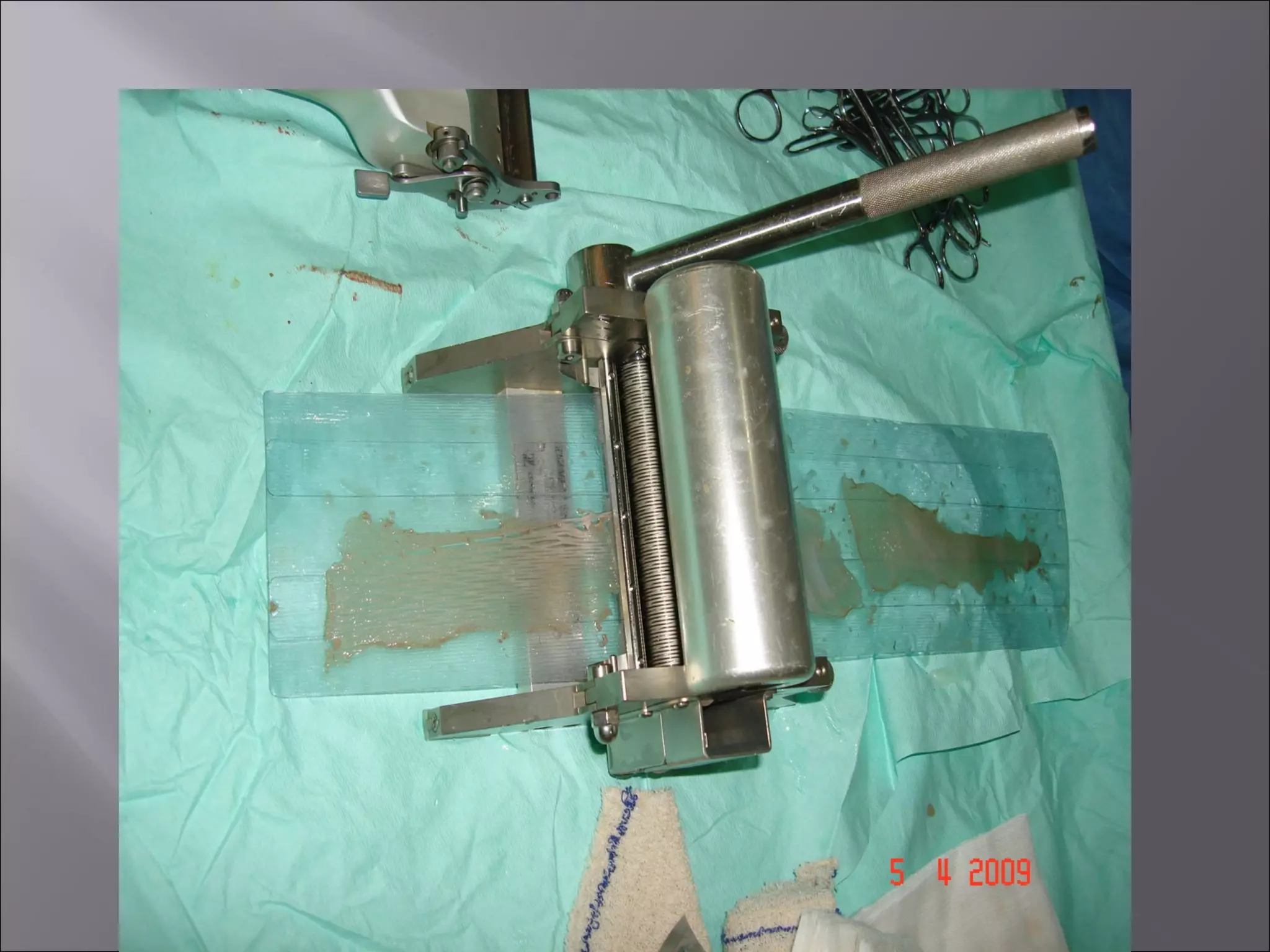 Skin graft , split skin grafting, STG , SSG , split thickness graft ...