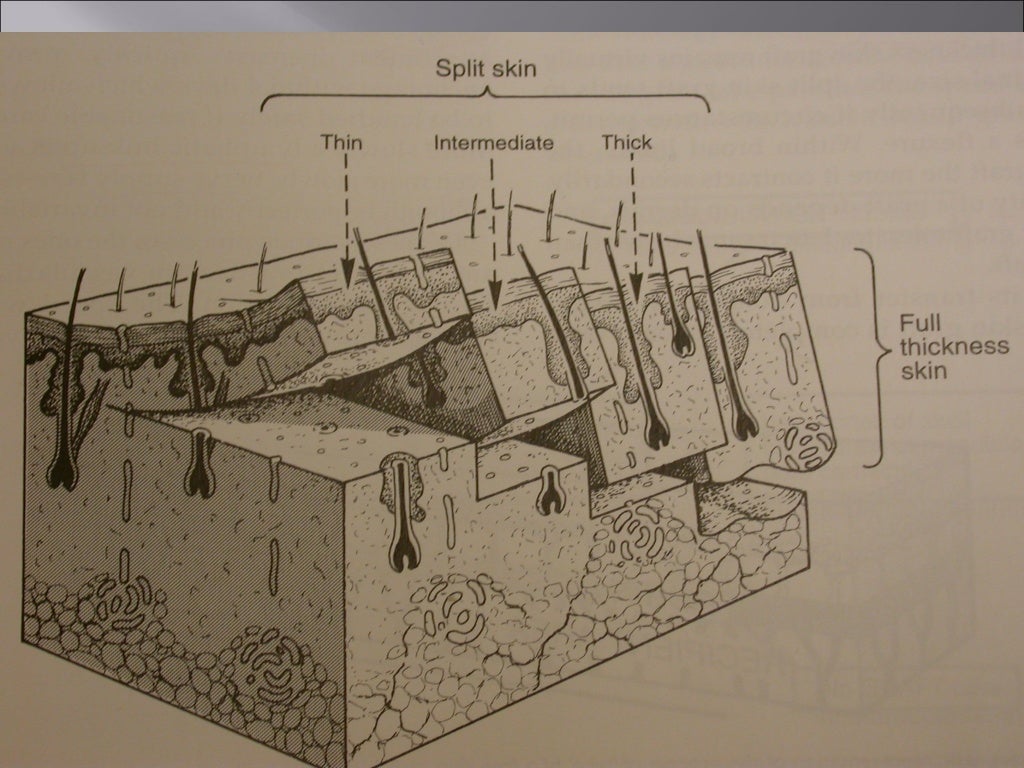 Skin graft , split skin grafting, STG , SSG , split thickness graft