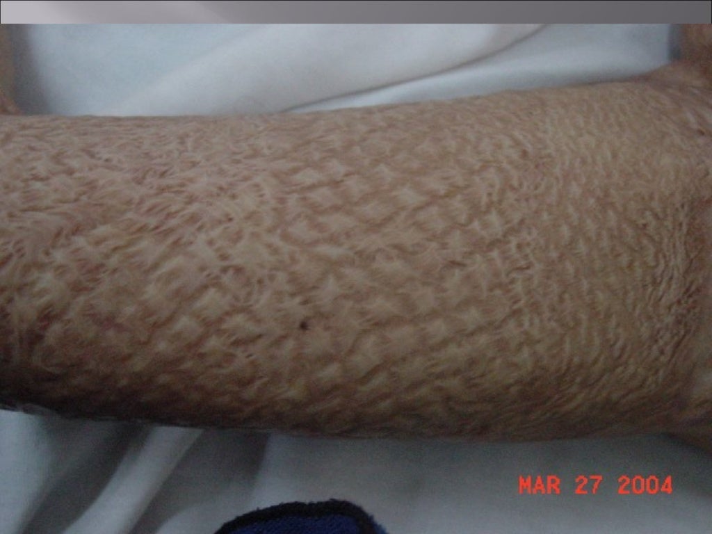 Skin graft , split skin grafting, STG , SSG , split thickness graft