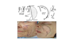 Skin grafts and flaps.pptx