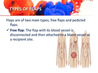 TYPES OF FLAPS
Flaps are of two main types, free flaps and pedicled
flaps.
 Free flap: The flap with its blood vessel is
disconnected and then attached to a blood vessel at
a recipient site.
 