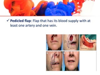  Pedicled flap: Flap that has its blood supply with at
least one artery and one vein.
 