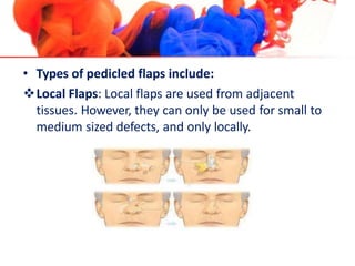 • Types of pedicled flaps include:
Local Flaps: Local flaps are used from adjacent
tissues. However, they can only be used for small to
medium sized defects, and only locally.
 