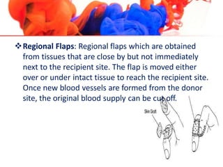 Regional Flaps: Regional flaps which are obtained
from tissues that are close by but not immediately
next to the recipient site. The flap is moved either
over or under intact tissue to reach the recipient site.
Once new blood vessels are formed from the donor
site, the original blood supply can be cut off.
 