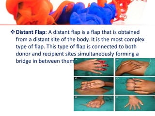 Distant Flap: A distant flap is a flap that is obtained
from a distant site of the body. It is the most complex
type of flap. This type of flap is connected to both
donor and recipient sites simultaneously forming a
bridge in between them.
 