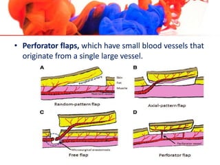 • Perforator flaps, which have small blood vessels that
originate from a single large vessel.
 