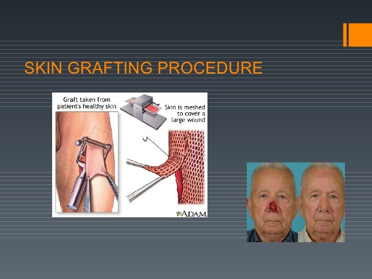 Skin grafting full