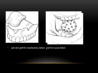 Split Mole Skin graft in oral and maxillofacial surgery | PPTX