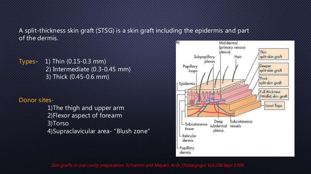 Skin grafts in oral and maxillofacial surgery