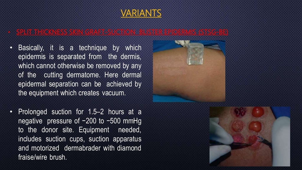 Skin grafts in oral and maxillofacial surgery