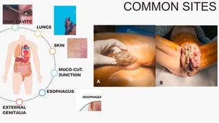 COMMON SITES
ORAL CAVITY
LUNGS
SKIN
MUCO-CUT.
JUNCTION
ESOPHAGUS
EXTERNAL
GENITALIA
 