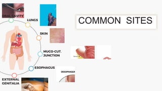 EXTERNAL
GENITALIA
COMMON SITES
ORAL CAVITY
LUNGS
SKIN
MUCO-CUT.
JUNCTION
ESOPHAGUS
 