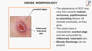 • The appearance of SCC may
vary from smooth nodular,
verrucous, papillomatous
to ulcerating lesions. All
ulcerate eventually, as they
grow.
• The ulcers have a
characteristic everted edge
and are surrounded by
inflammed, indurated skin.
• Bloody Discharge can be
present
GROSS MORPHOLOGY
everted edges
inflammed
indurated
skin
 