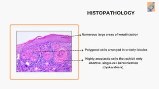 HISTOPATHOLOGY
Numerous large areas of keratinization
Polygonal cells arranged in orderly lobules
Highly anaplastic cells that exhibit only
abortive, single-cell keratinization
(dyskeratosis).
 