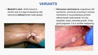 • Marjolin's ulcer which occurs in
chronic scar is a type of squamous cell
carcinoma without lymph node spread.
VARIANTS
• Verrucous carcinoma is a squamous cell
carcinoma, commonly occurring in mucous
membrane or mucocutaneous junction
without lymph node spread. It is dry,
exophytic, warty, indurated growth. It has
good prognosis. It is a curable malignancy.
 