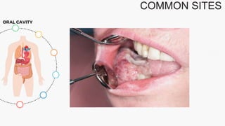 COMMON SITES
ORAL CAVITY
 