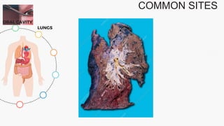 COMMON SITES
ORAL CAVITY
LUNGS
 