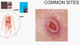 COMMON SITES
ORAL CAVITY
LUNGS
SKIN
 