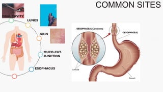 COMMON SITES
ORAL CAVITY
LUNGS
SKIN
MUCO-CUT.
JUNCTION
ESOPHAGUS
 