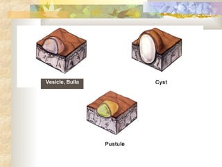 Vesicle, Bulla 