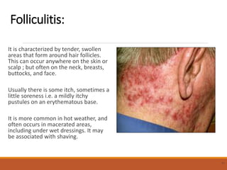 Folliculitis:
It is characterized by tender, swollen
areas that form around hair follicles.
This can occur anywhere on the skin or
scalp ; but often on the neck, breasts,
buttocks, and face.
Usually there is some itch, sometimes a
little soreness i.e. a mildly itchy
pustules on an erythematous base.
It is more common in hot weather, and
often occurs in macerated areas,
including under wet dressings. It may
be associated with shaving.
11
 