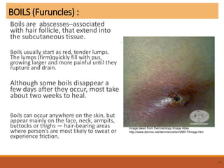 BOILS (Furuncles) :
Boils are abscesses–associated
with hair follicle, that extend into
the subcutaneous tissue.
Boils usually start as red, tender lumps.
The lumps (firm)quickly fill with pus,
growing larger and more painful until they
rupture and drain.
Although some boils disappear a
few days after they occur, most take
about two weeks to heal.
Boils can occur anywhere on the skin, but
appear mainly on the face, neck, armpits,
buttocks or thighs — hair-bearing areas
where person’s are most likely to sweat or
experience friction.
15
Image taken from Dermatology Image Atlas.
http://www.dermis.net/dermisroot/en/26817/image.htm
 
