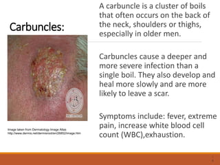 Carbuncles:
A carbuncle is a cluster of boils
that often occurs on the back of
the neck, shoulders or thighs,
especially in older men.
Carbuncles cause a deeper and
more severe infection than a
single boil. They also develop and
heal more slowly and are more
likely to leave a scar.
Symptoms include: fever, extreme
pain, increase white blood cell
count (WBC),exhaustion.
1
6
Image taken from Dermatology Image Atlas
http://www.dermis.net/dermisroot/en/26852/image.htm
 