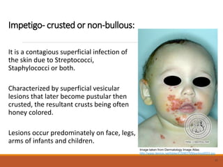 Impetigo- crusted or non-bullous:
It is a contagious superficial infection of
the skin due to Streptococci,
Staphylococci or both.
Characterized by superficial vesicular
lesions that later become pustular then
crusted, the resultant crusts being often
honey colored.
Lesions occur predominately on face, legs,
arms of infants and children.
21
Image taken from Dermatology Image Atlas
http://www.dermis.net/bilder/CD067/550px/img0033.jpg
 